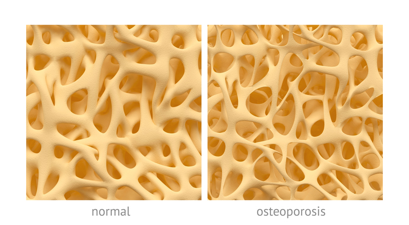 Knochen mit normaler Struktur und mit Struktur bei Osteoporose.